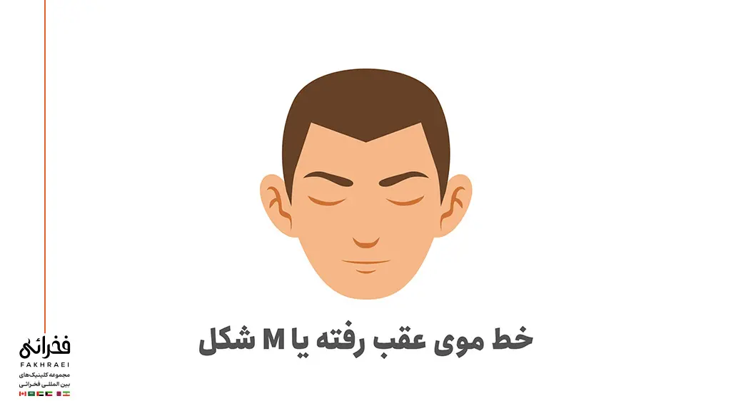 خط رویش موی M شکل