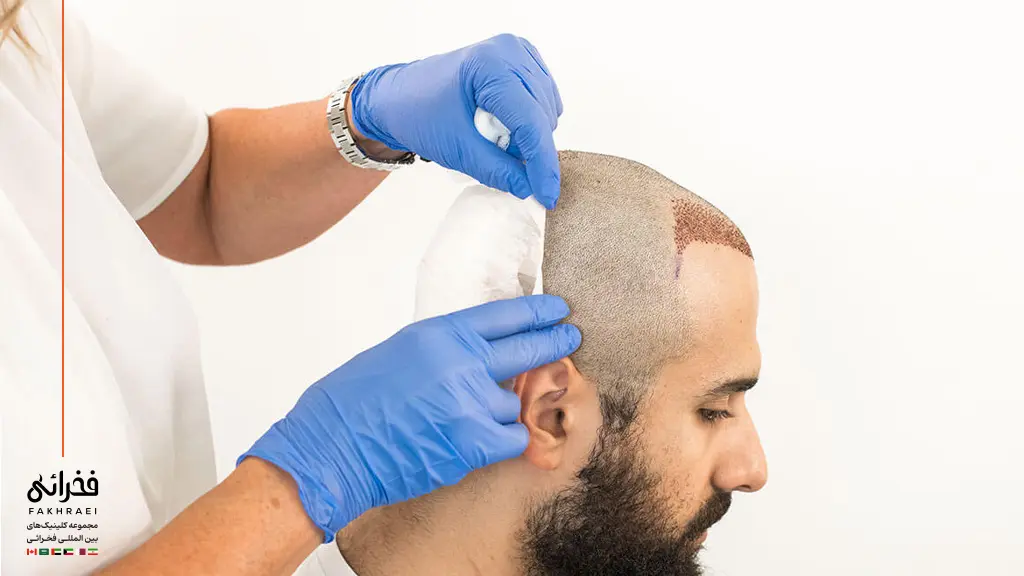 یک فرد مناسب برای کاشت مو به روش FUT