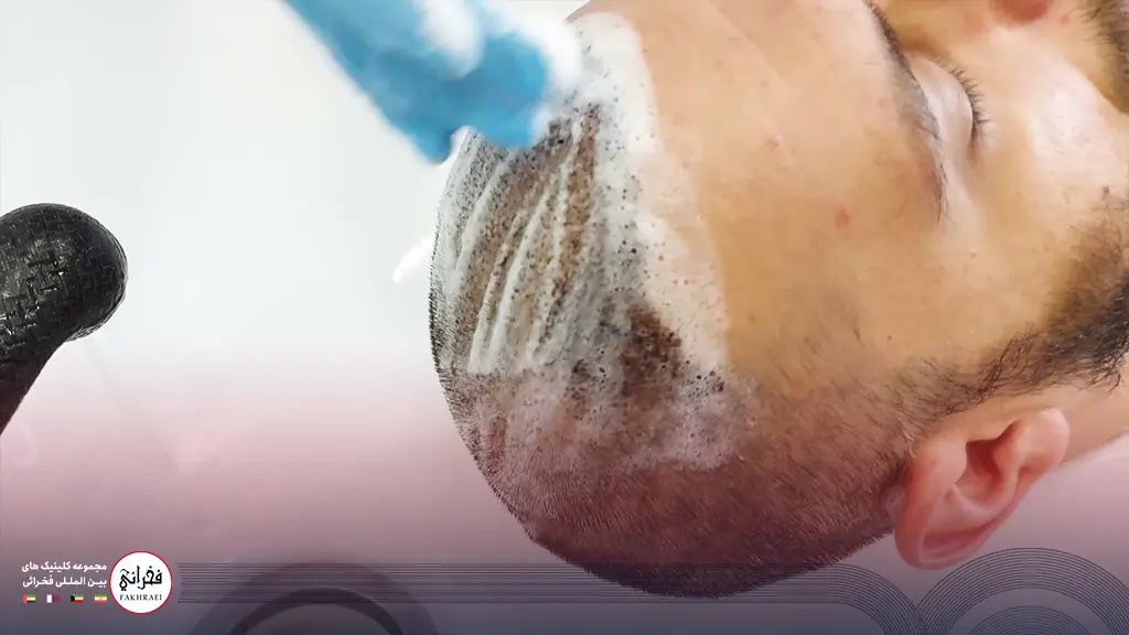 شستشوی زخم کاشت مو