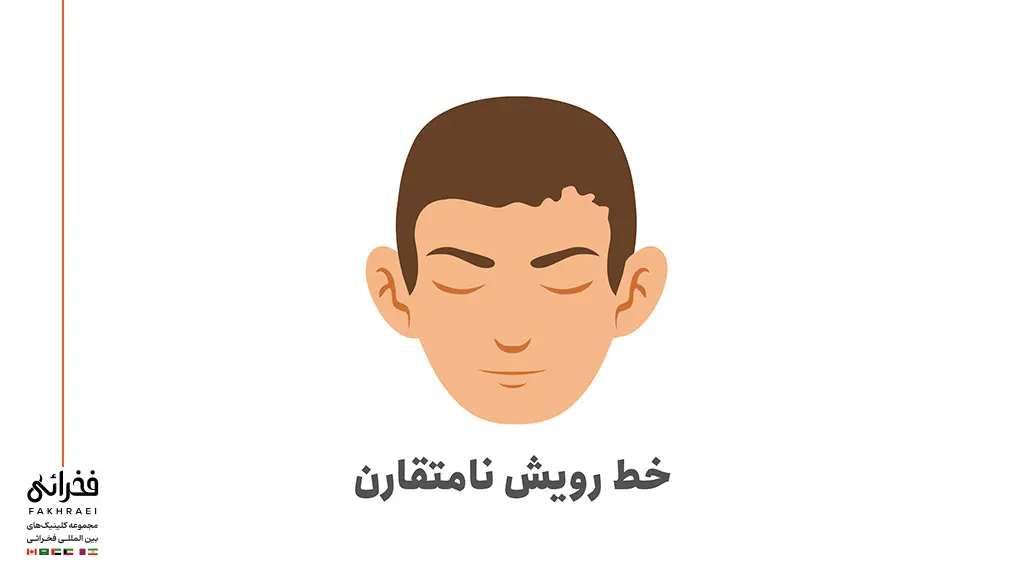 خط رویش مو نامتقارن