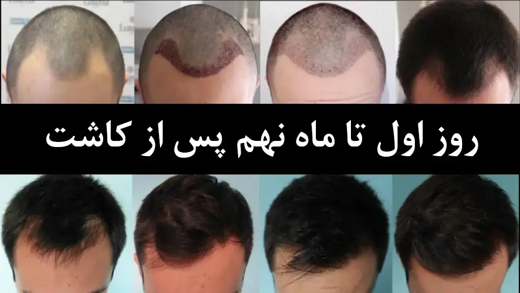 عکس مراحل رشد مو بعد از کاشت