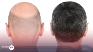 اقدامات قبل از کاشت مو