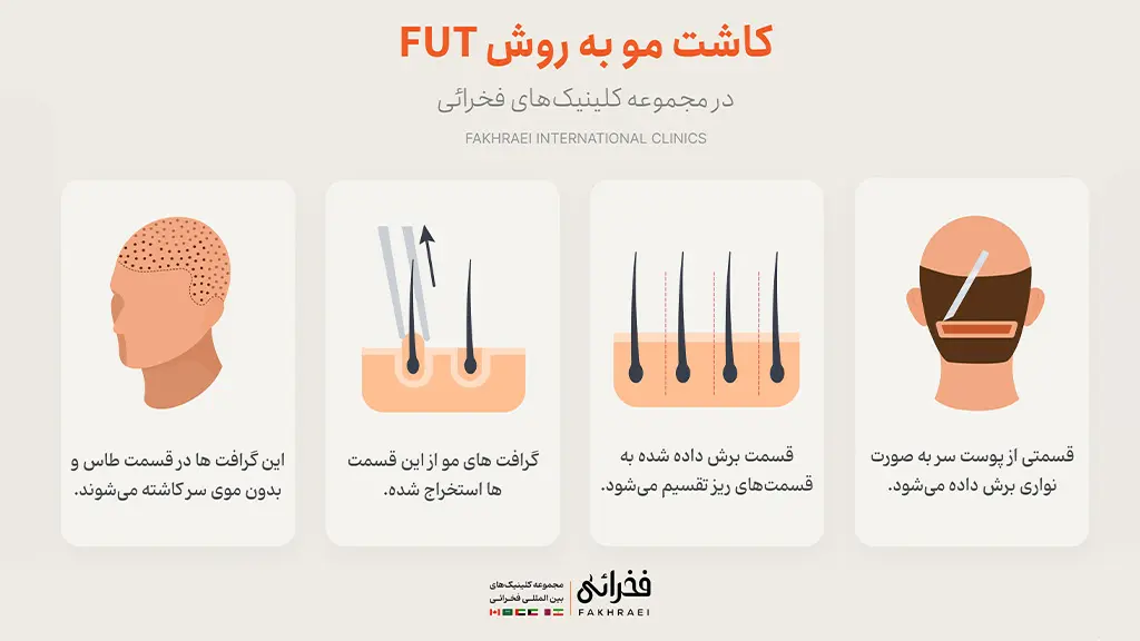مراحل انجام کاشت مو به روش fut