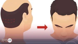 کاشت مو به روش FUT