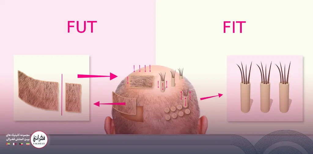 کاشت مو به روش FIT بهتر است یا FUT؟