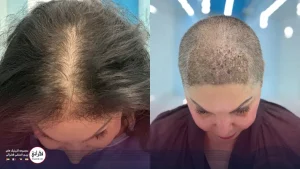 کاشت مو برای زنان