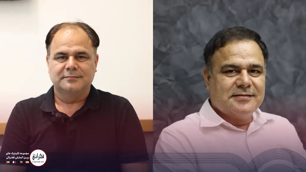 کاشت مو در بهترین کلینیک تهران