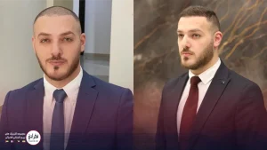 نظرات و تجربیات کسانی که کاشت مو انجام داده اند