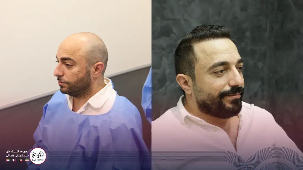 کاشت مو در کلینیک فخرایی
