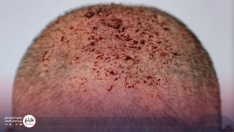 زخم بعد از کاشت مو