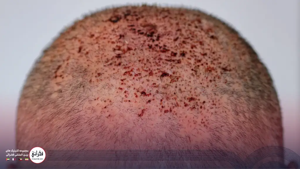 زخم بعد از کاشت مو