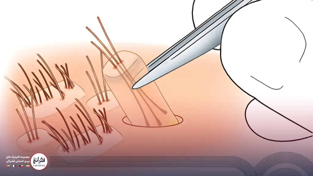 برداشت گرافت مو