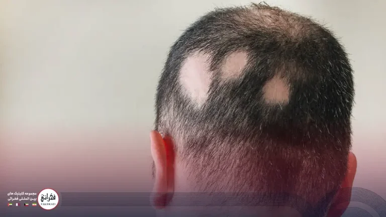 ریزش موی سکه‌ ای