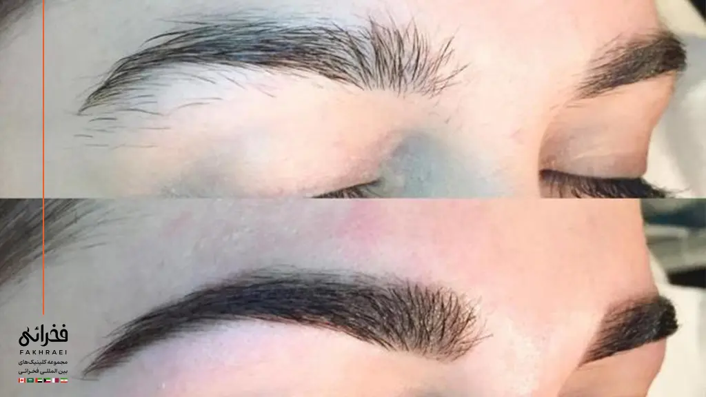 رشد نامنظم ابرو پس از کاشت ابرو ناموفق