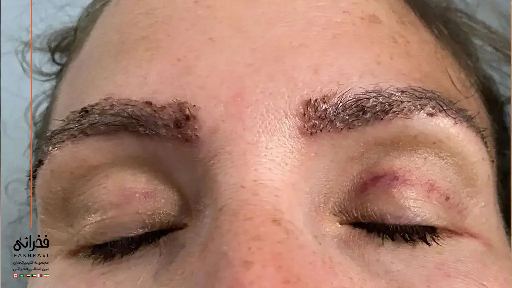 رشد نامنظم ابرو در عوارض کاشت ابرو