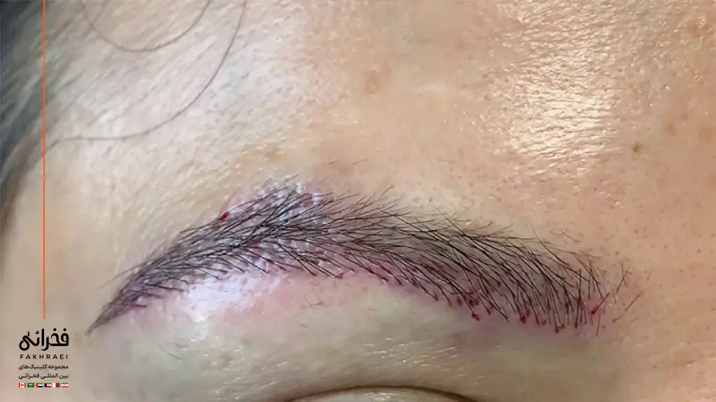 ایجاد خونریزی جزئی در عوارض کاشت ابرو