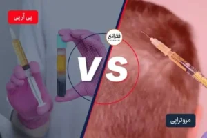 PRP-Mesotherapy-768x512 (1)