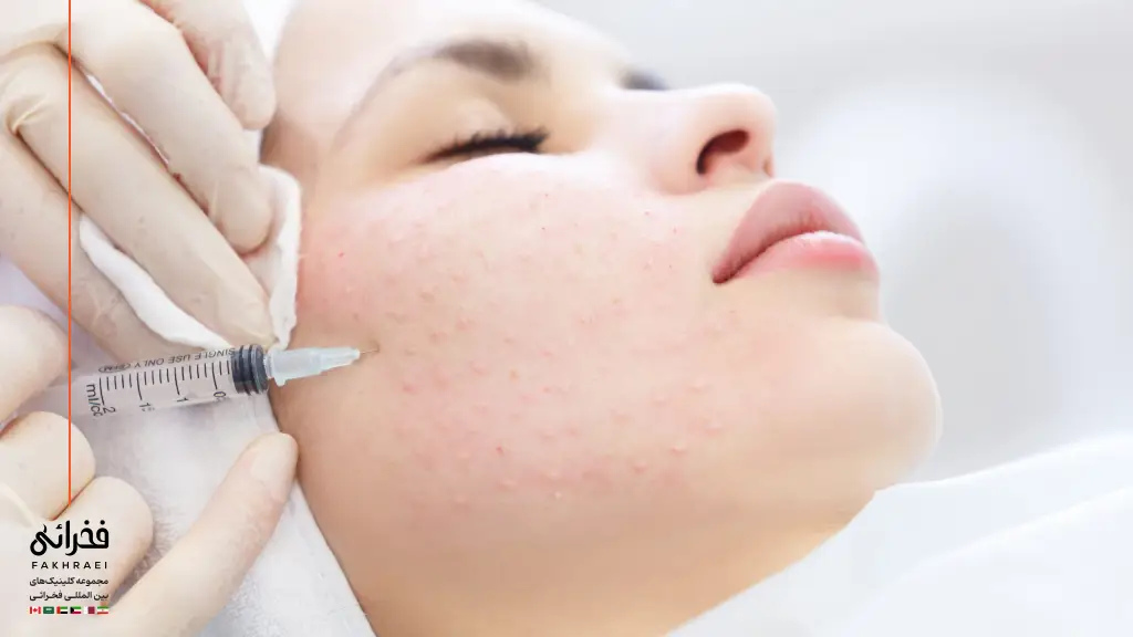 مراحل انجام مزوتراپی صورت