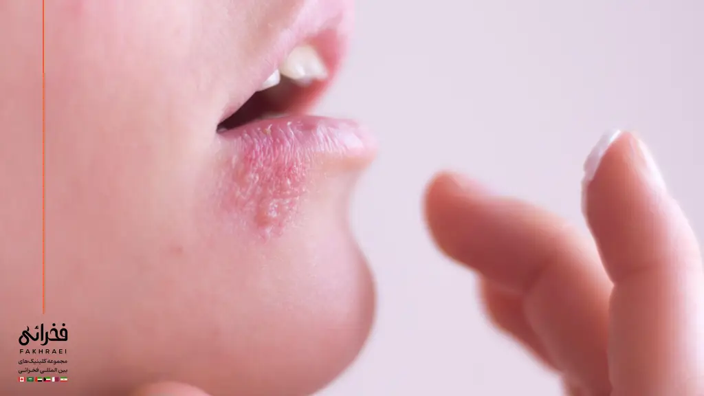 عدم تحریک تبخال