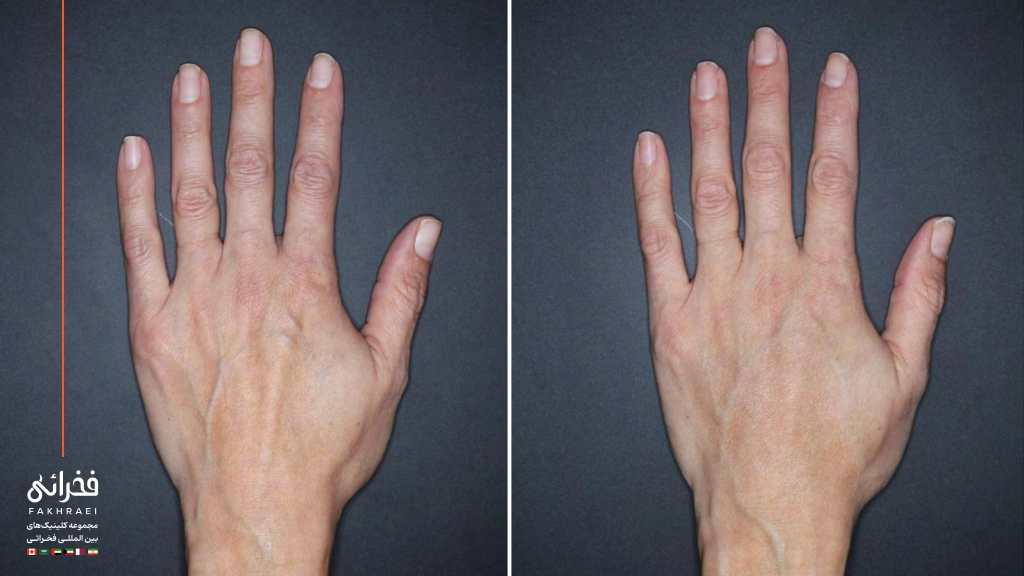 فیلر بادی برای پشت دست