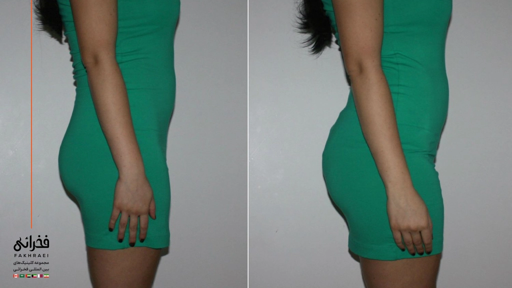 لیفت باسن با چربی و فیلر