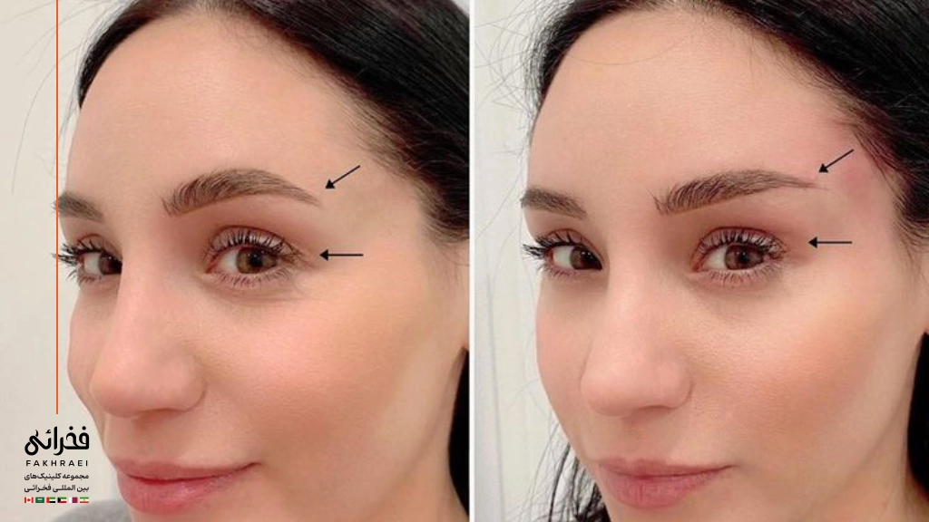 عکس قبل و بعد لیفت شقیقه با بوتاکس