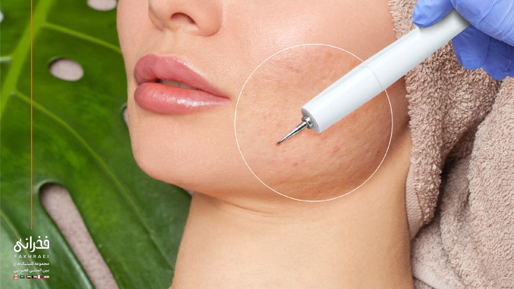 نحوه انجام سابسیژن صورت