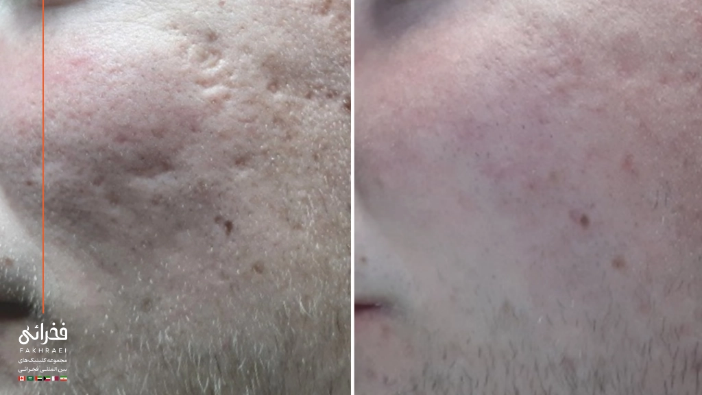 مزایای سابسیژن صورت