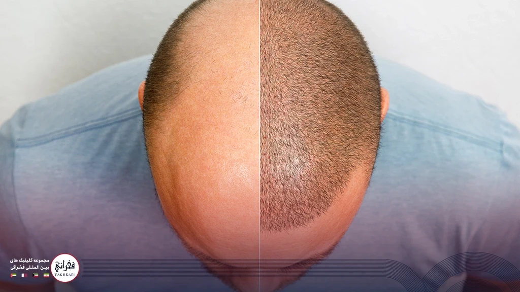 کاشت مو با تراکم بالا