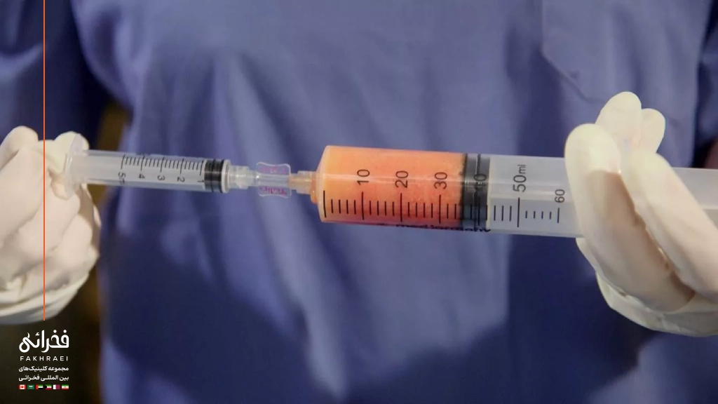 تزریق چربی به باسن چگونه انجام میشود؟