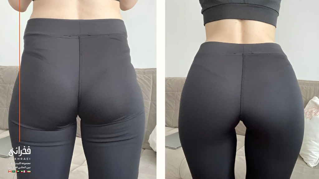 فیلر هیپ دیپ چیست