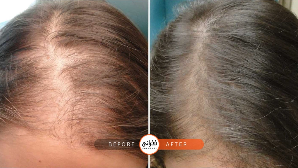 اگزوزوم برای درمان ریزش مو