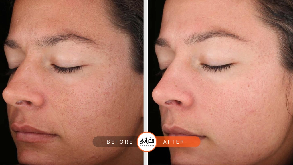 اگزوزوم برای اسکار