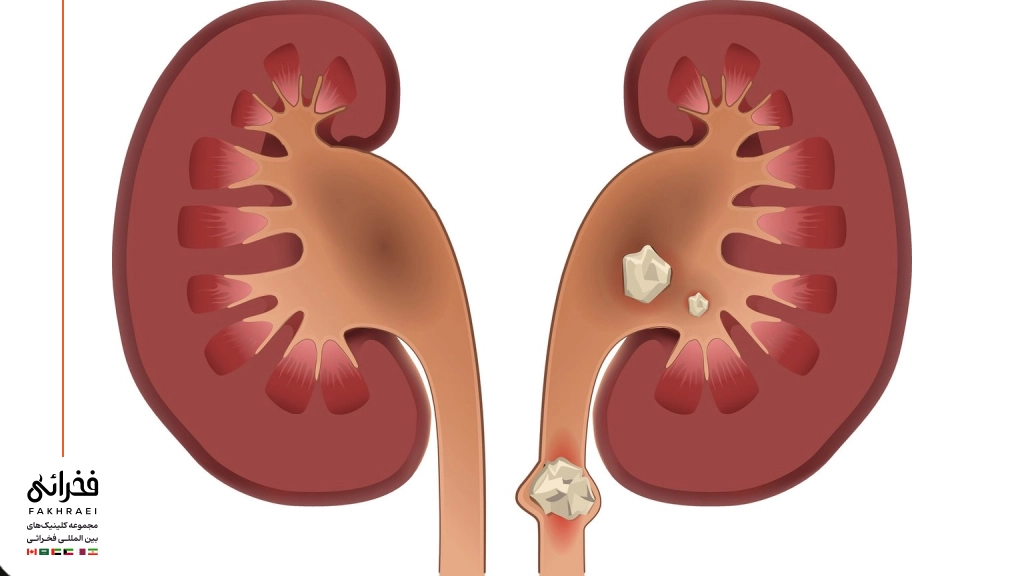 تکرر ادرار به دلیل سنگ کلیه