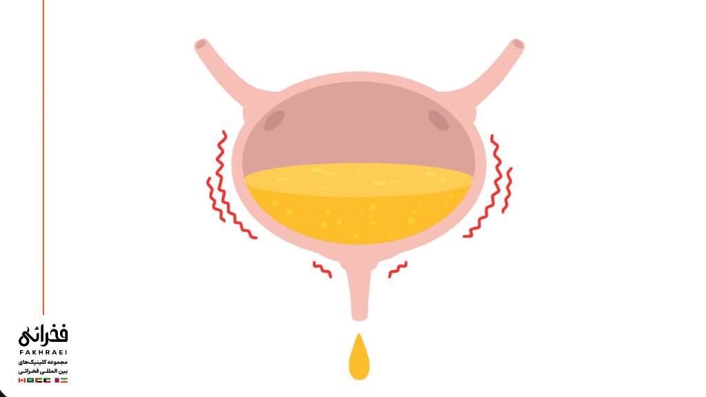 تکرر ادرار به علت مثانه بیش فعال
