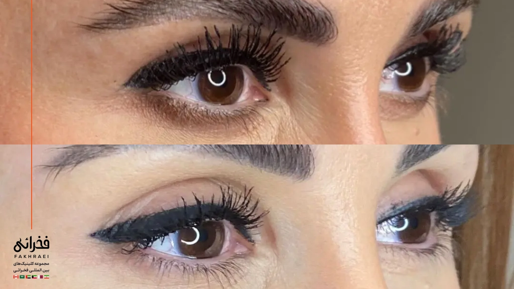 عکس قبل و بعد از لیفت چشم روباهی