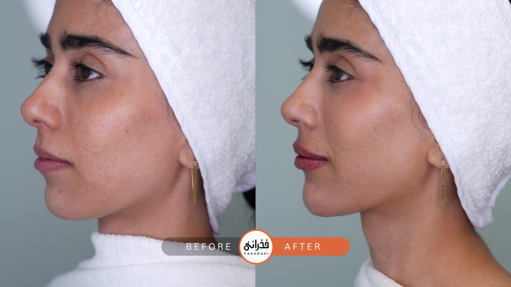 عکس قبل و بعد از فیلر چانه