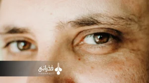 علت ریزش ابرو