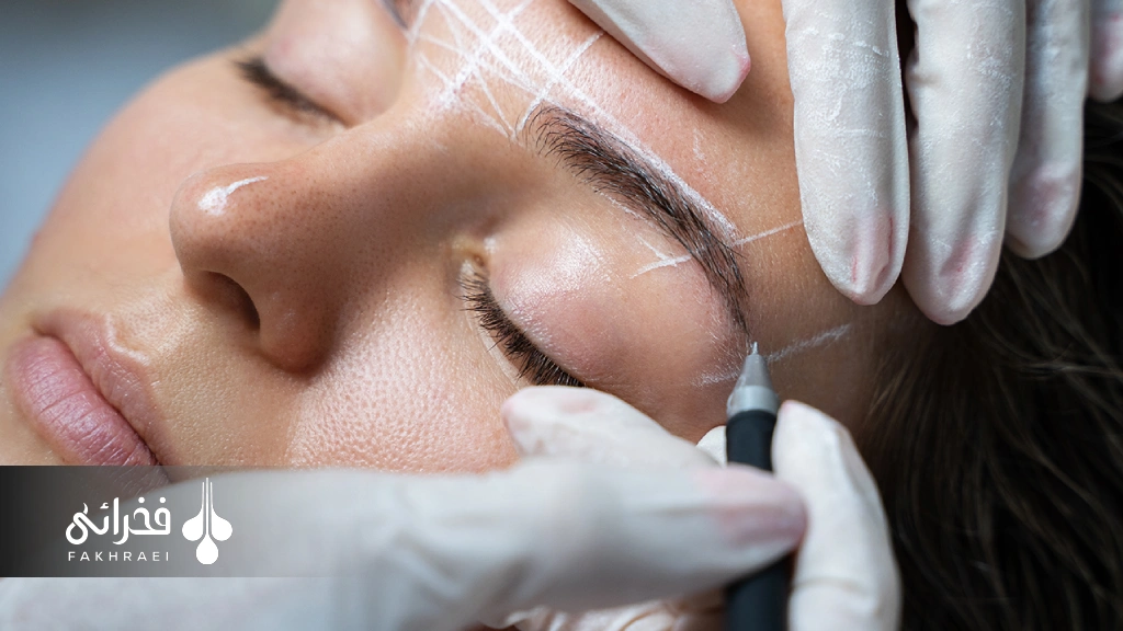 کاشت ابرو برای درمان ریزش ابرو