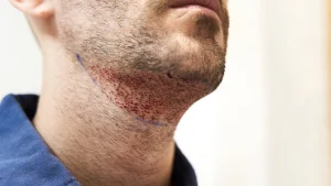 کاشت مو از ریش