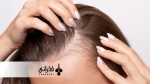 ریزش مو ناشی از سندرم تخمدان