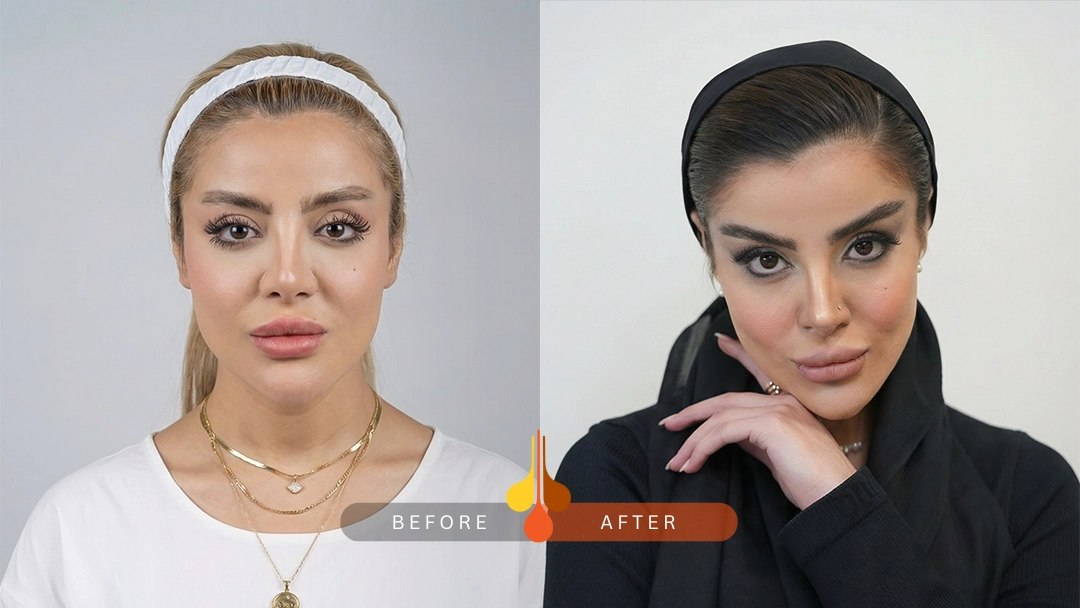 نتیجه طبیعی کاشت ابرو NFT در کلینیک فخرایی