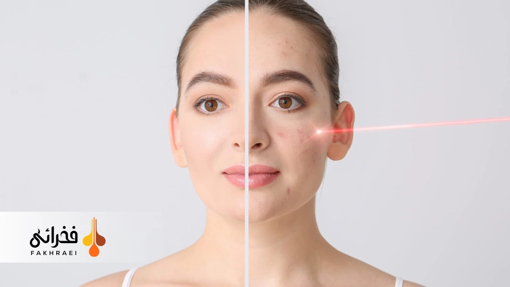 استفاده از لیزر برای جوانسازی پوست و از بین بردن لک