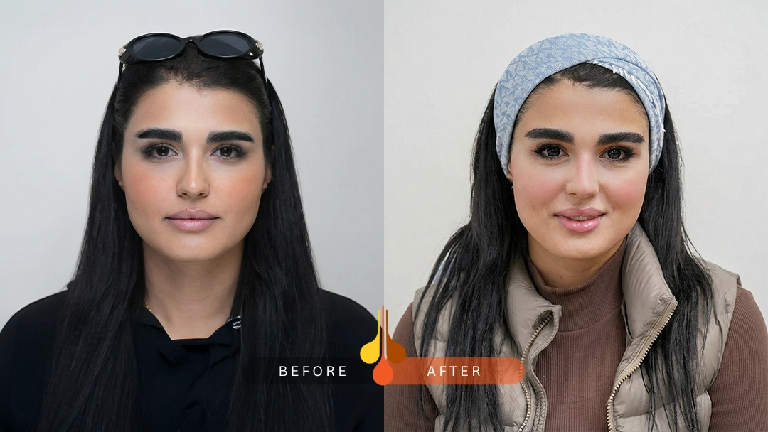 نتیجه طبیعی کاشت ابرو NFT در کلینیک فخرایی