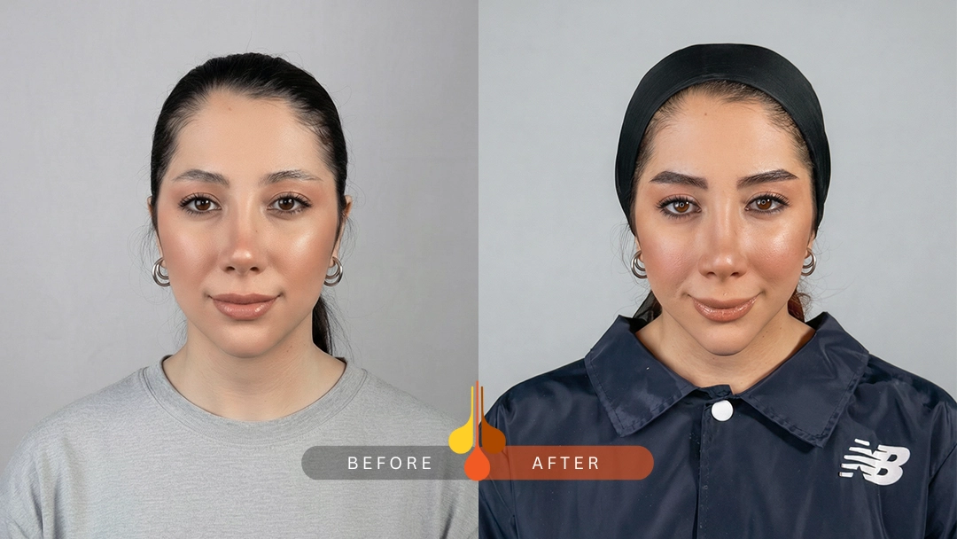 نتیجه طبیعی کاشت ابرو NFT در کلینیک فخرایی