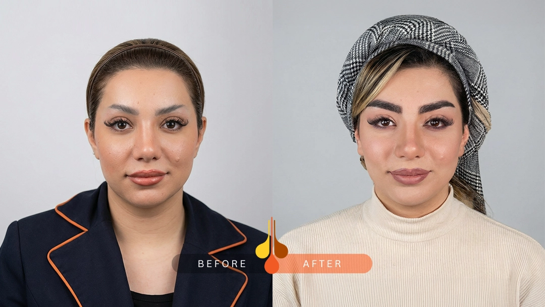 نتیجه طبیعی کاشت ابرو NFT در کلینیک فخرایی