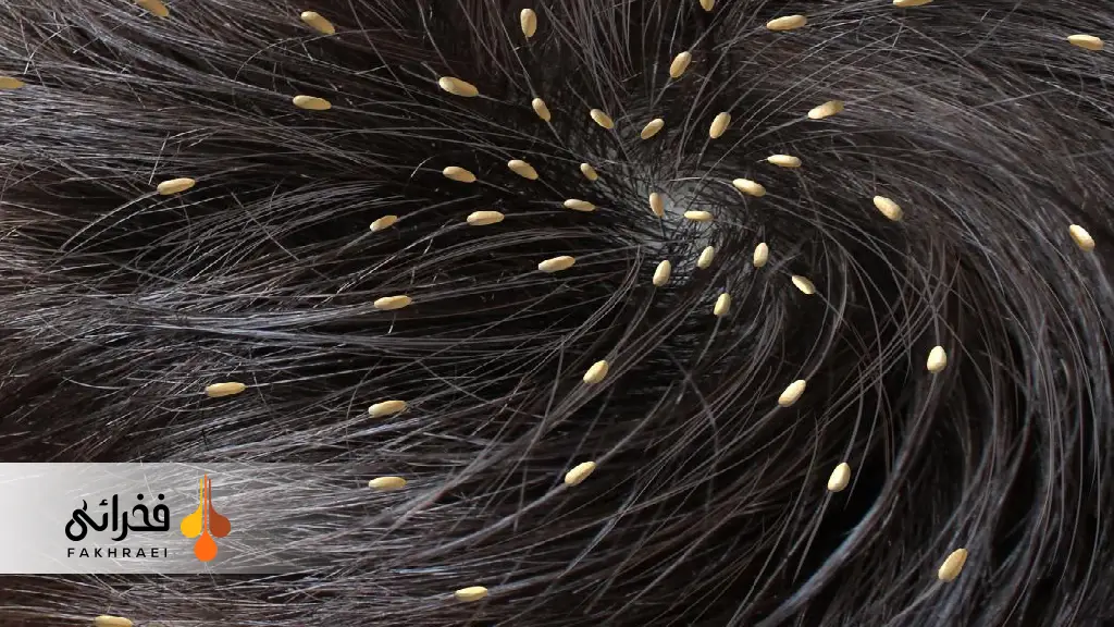 تشخیص شپش سر چگونه انجام میشود؟