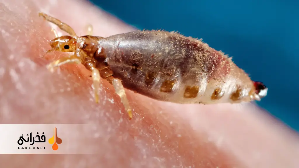 شپش سر چیست و چرا بهوجود میآید؟