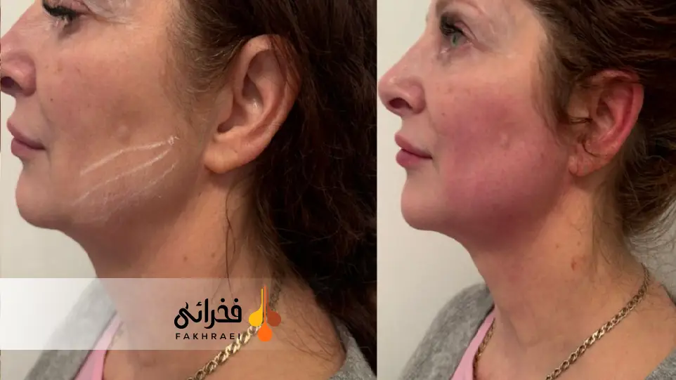 قبل و بعد از انجام اندولیفت 