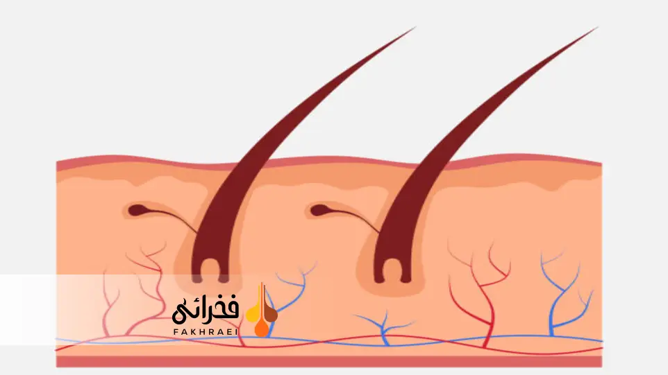 ارتباط DHT و ریزش موی مردانه